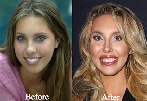 chloe lattanzi before plastic surgery|Chloe Lattanzi's plastic surgery transformation .